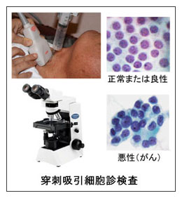 甲状腺腫瘍 北海道 帯広 十勝 社会医療法人北斗 北斗病院 北斗クリニック