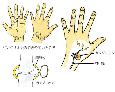 ガングリオン 悪性 見分け 方