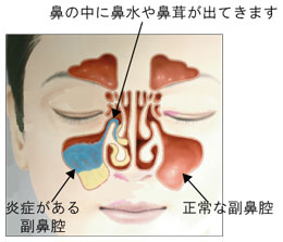 炎 手術 鼻腔 副