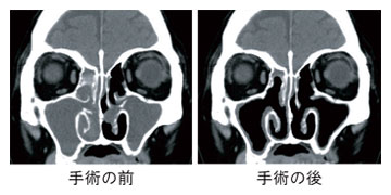 鼻腔 慢性 炎 副 副鼻腔炎・蓄膿症の名医・専門医42名