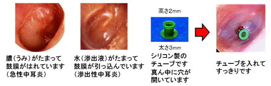 反復性中耳炎 滲出性中耳炎における鼓膜チューブ治療 北海道 帯広 十勝 社会医療法人北斗 北斗病院 北斗クリニック