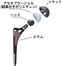 人工股関節置換術 北海道 帯広 十勝 社会医療法人北斗 北斗病院 北斗クリニック