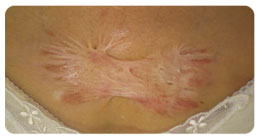 形成外科で対象となる疾患例 北海道 帯広 十勝 社会医療法人北斗 北斗病院 北斗クリニック