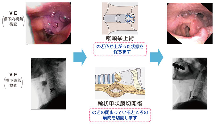 嚥下障害に対する嚥下機能改善手術