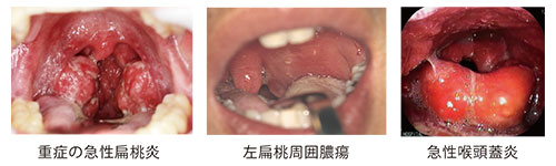 急性扁桃炎、扁桃周囲膿瘍、急性喉頭蓋炎