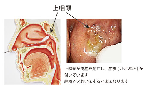 慢性上咽頭炎