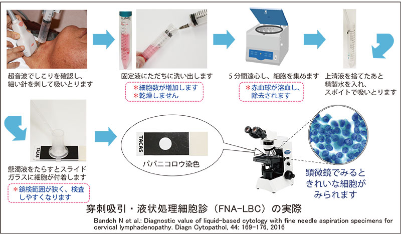 穿刺吸引・液状処理細胞診