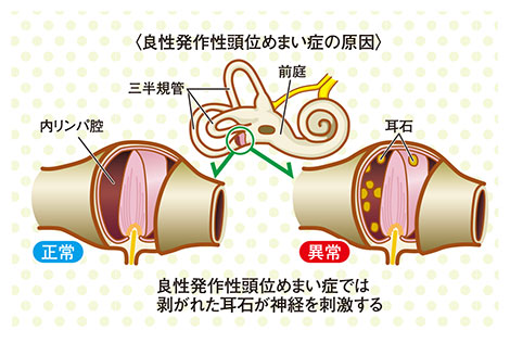 良性発作性頭位めまい症の原因