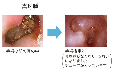 真珠腫性中耳炎