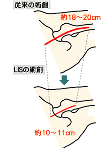 LISの術創