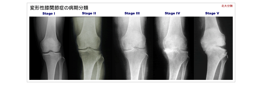 変形性膝関節症ステージ分類