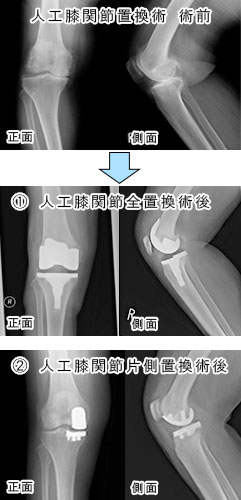 人工関節置換術