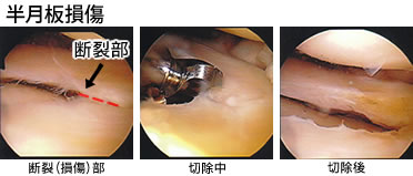 半月板損傷