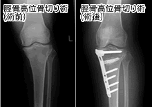 関節鏡視下手術