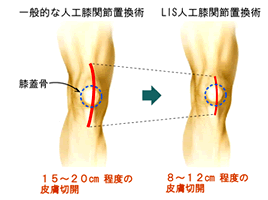 LISとは、筋肉や軟部組織に対する負担をできるだけ最小限に行う手術方法です。